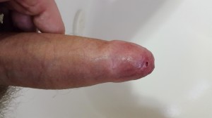 Erect penis with severe phimosis (tight foreskin)