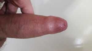 Erect penis with pinhole phimosis