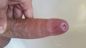Penis with tight foreskin