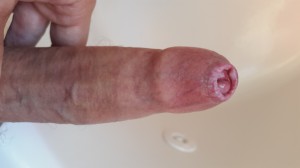Penis after stretching phimosis